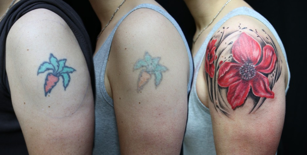 Laser Tattoo Removal For A Better Career And Life