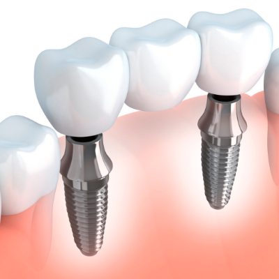 Dental Implant Restoration Technique