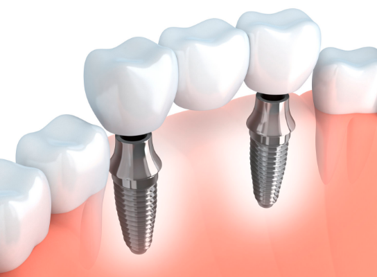 Dental Implant Restoration Technique